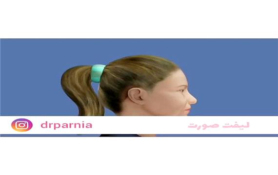 ‌لیفت صورت