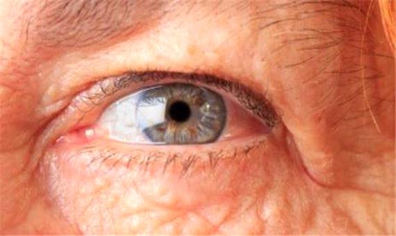 درمان تنبلی چشم سالمندان