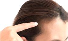 ریزش موی هورمونی به چه معناست؟