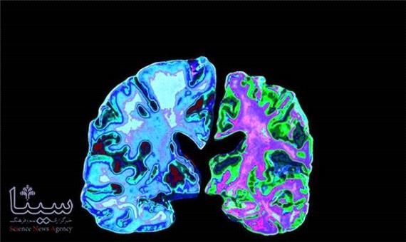 مغز مبتلایان به آلزایمر دارای جهش های ژنتیکی بیشتری است
