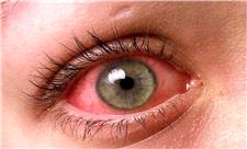 چگونه تورم و قرمزی چشم را با گیاهان دارویی درمان کنیم؟