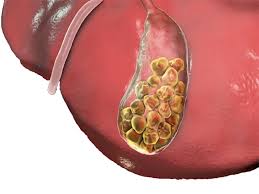 مهم‌ترین عامل سنگ کیسه صفرا غذاهای چرب است