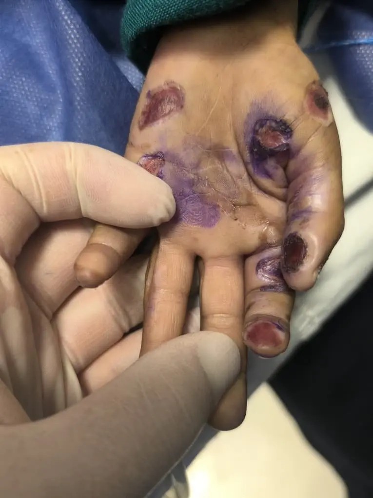 بچه ۴ ساله هرمزگانی قربانی کودک‌آزاری شد