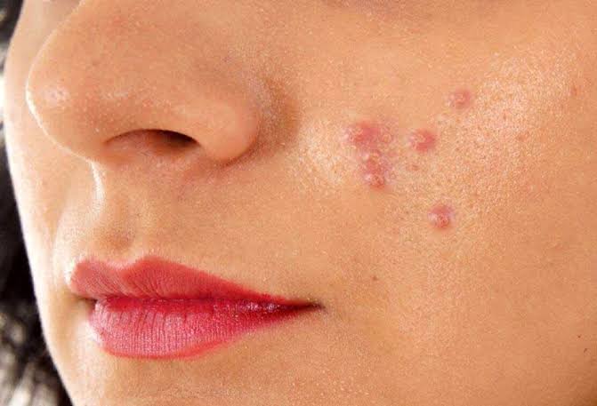 ماسک خانگی برای درمان جوش