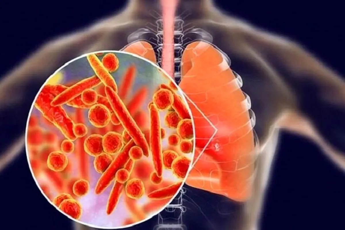پنومونی؛ همچنان بزرگ‌ترین قاتل عفونی جهان