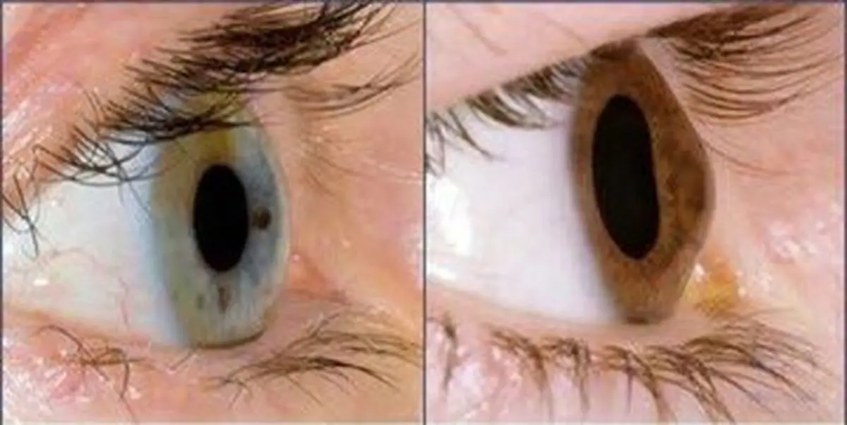 استفاده مداوم از موبایل و لپ تاپ باعث قوز قرنیه می‌شود؟