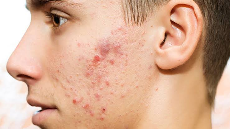 دلیل ایجاد جوش بعد از بلوغ چیست؟