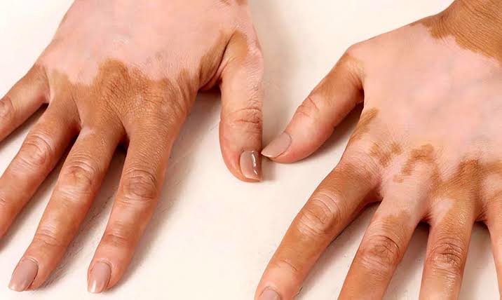 تعریفی از بیماری پیسی پوست