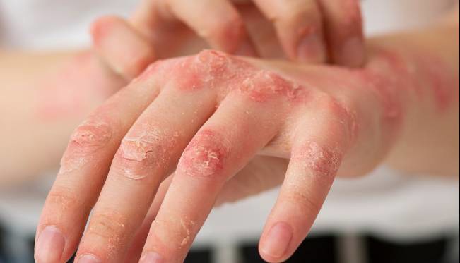 راه‌های آسان برای کنترل اگزما