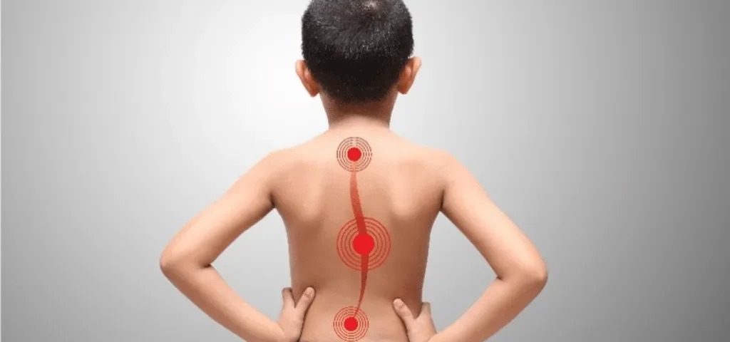 اقدامات لازم والدین برای کودک دارای اسکولیوز