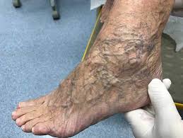 چه عواملی باعث بیماری واریس در یک فرد میشود؟