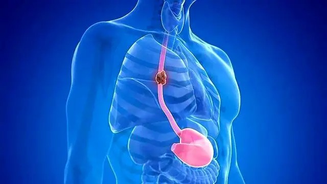 چه چیزی باعث سرطان مری می‌شود؟