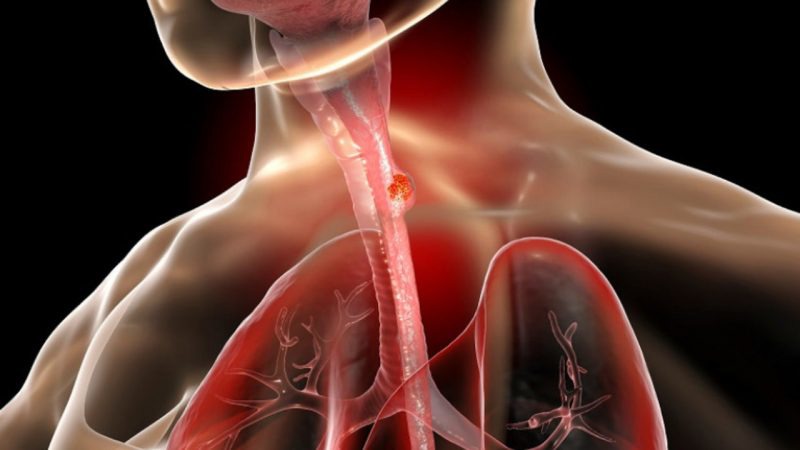 چه عواملی باعث سرطان مری می‌شود؟