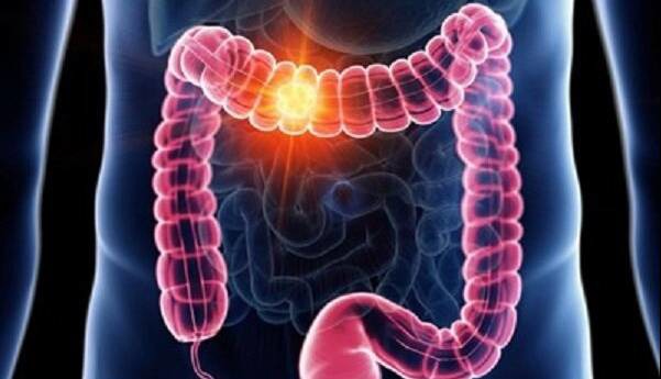 عوامل موثر در بروز سرطان روده؛ تغییر اجابت مزاج را جدی بگیرید