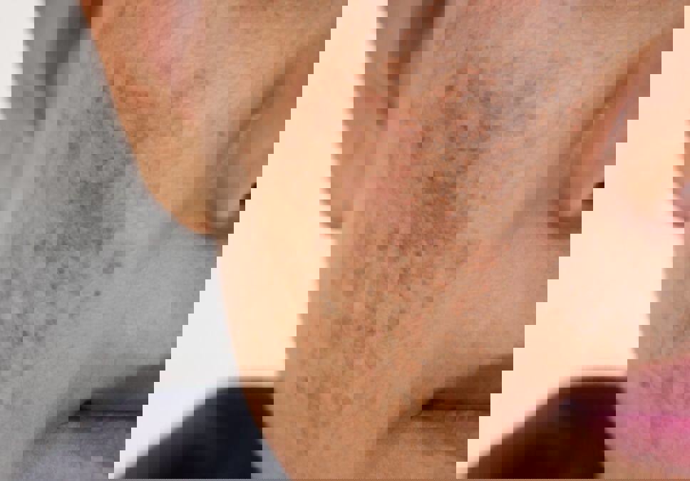 دمنوشی که سه ماهه لک‌های پوستی را کاهش می‌دهد!