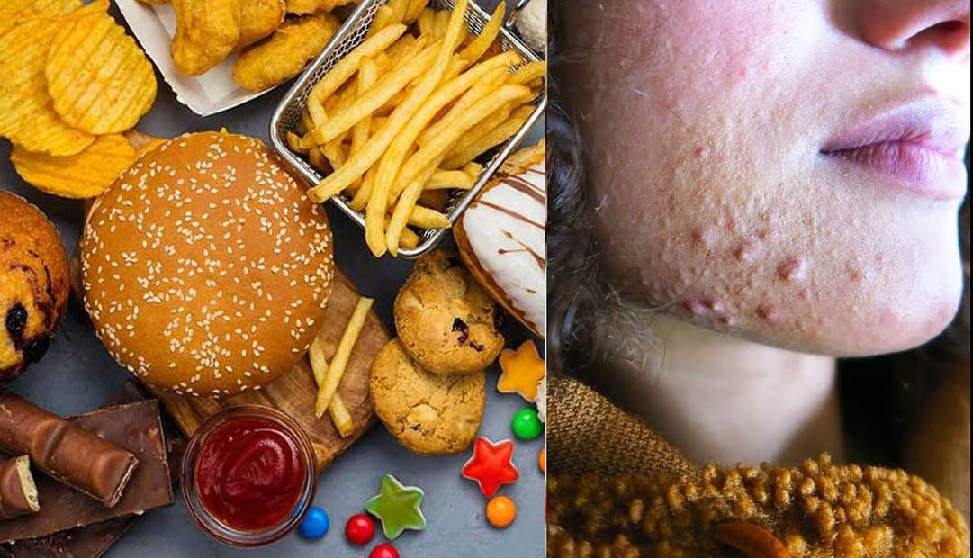 چند ماده غذایی که اکنه را فعال می‌کند