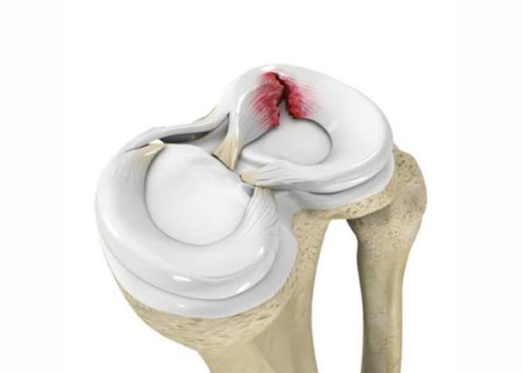 عواقب جبران ناپذیر نادیده گرفتن پارگی منیسک زانو!