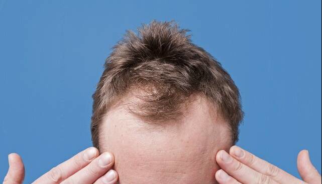 کدام ریزش مو در مردان شایع‌تر است؟