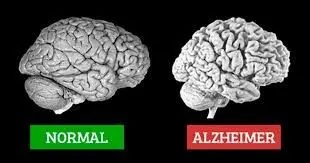 آلزایمر چیست، نشانه هایش کدام است و چه کنیم مبتلا نشویم؟