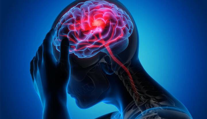 تحریک نخاع به بازیابی قدرت بازو پس از سکته مغزی کمک می کند