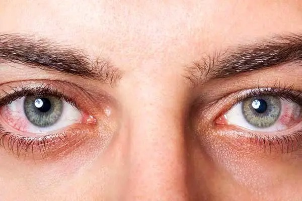 دیابت، شایع ترین علت قابل پیشگیری کوری