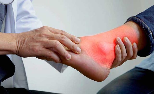 کنترل دردهای نقرس با توصیه‌های طب سنتی