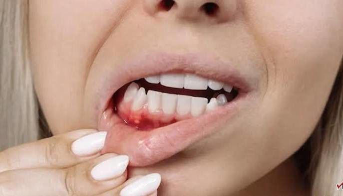 بیماری لثه بی‌سروصدا پیشرفت می‌کند؛ مراقب این علائم باشید
