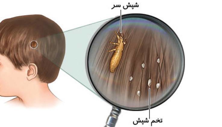 شپش سر؛ چالش همیشگی مدارس