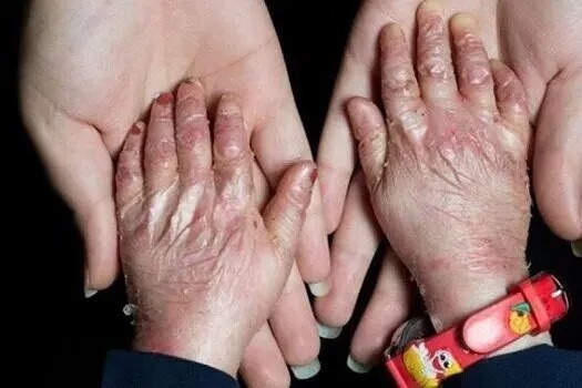 به داد بیماران پروانه ای برسید